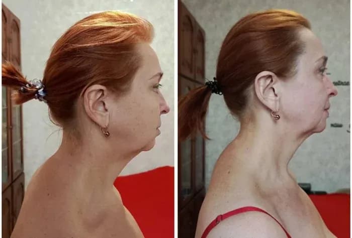 Age: 58 years · Using the method for: 2 months. The double chin has significantly reduced. The neck has become longer and more defined. Jawline contour is visibly sharper. Posture has improved with an elegant lift through the upper body. The overall profile looks firmer, lighter, and noticeably younger.