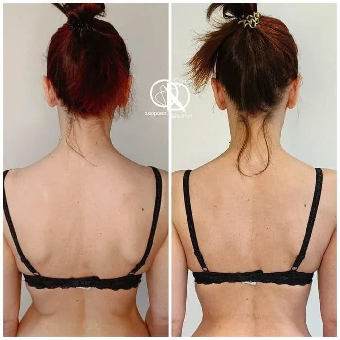 Age: 32 years · Using the method for: 1 week. The shoulders have become more level and relaxed. The spine looks more aligned and centered. Tension in the upper back has visibly reduced. The posture appears straighter and more balanced. The overall silhouette feels lighter and more harmonious.