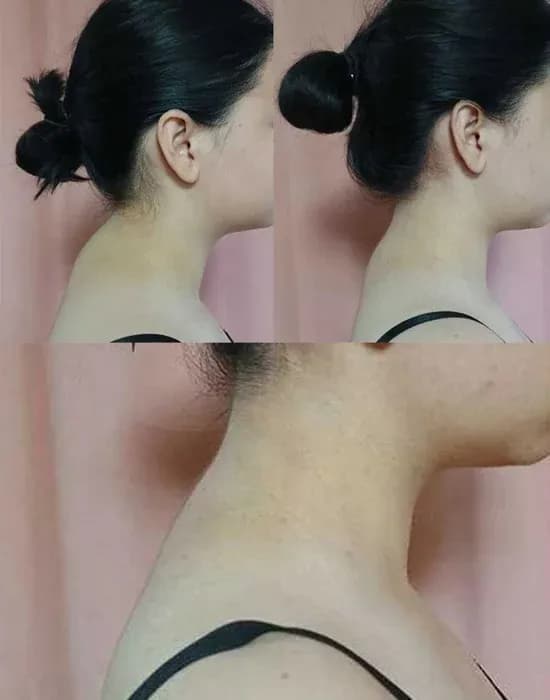 Age: 35 years · Using the method for: 2 weeks. The neck lengthened and the posture improved. The head and neck are clearly more aligned. The double chin area looks tighter. Shoulders appear more relaxed. The profile has become more elegant and uplifted.