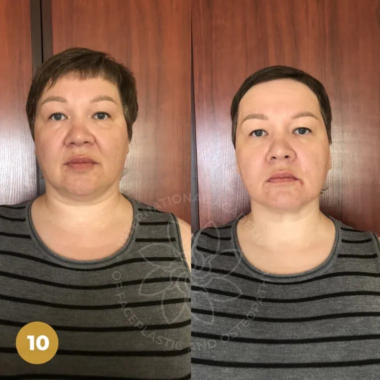Real client before and after — Jawline & jowls