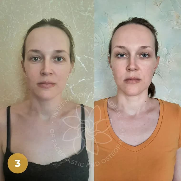 Real client before and after — Facial contour