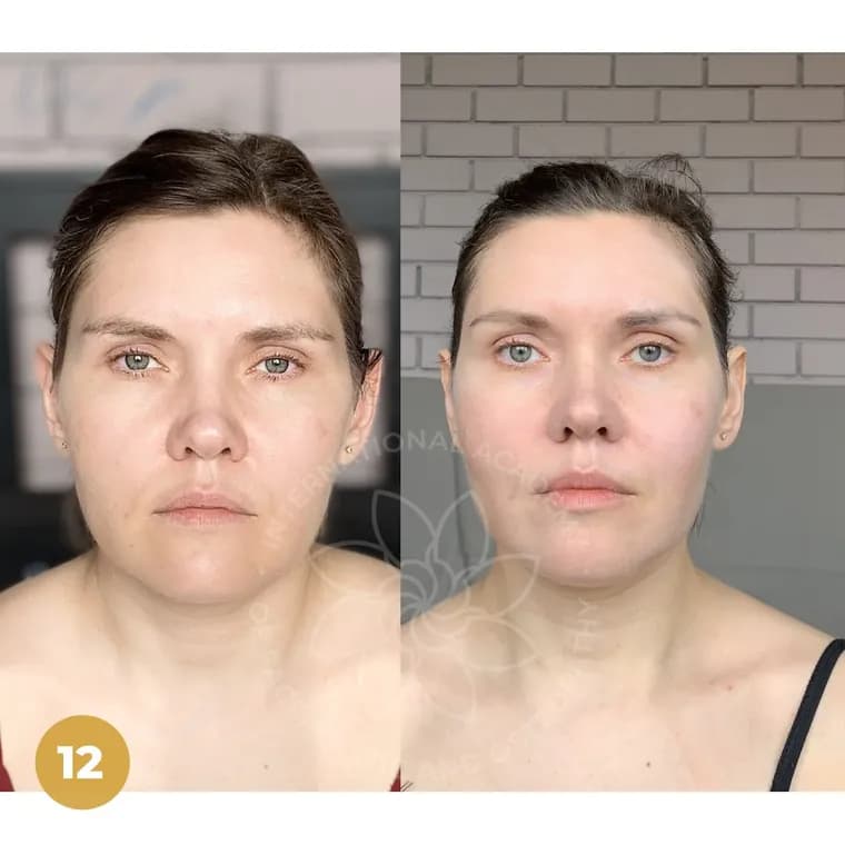 Real client before and after — Face & jawline