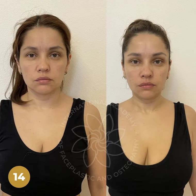 Real client before and after — Jawline & oval