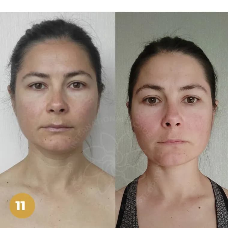 Real client before and after — Cheekbones & contour