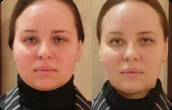 Facial contours look more defined, skin texture smoother, and the face overall appears fresher and more balanced.