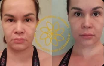 Wrinkles softened, the eyes look more open, facial contours tightened, and the face appears younger.