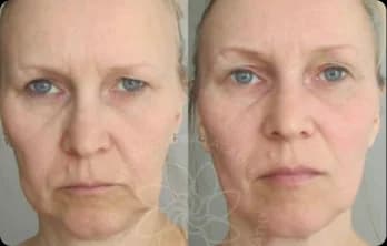 Swelling disappeared, facial contours tightened, and the face looks more sculpted and youthful.