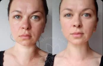 Facial puffiness disappeared; now the face looks younger and more refined.