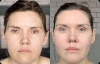 Contours look more sculpted, with better symmetry and less puffiness. The skin appears smoother and the face — renewed and youthful.