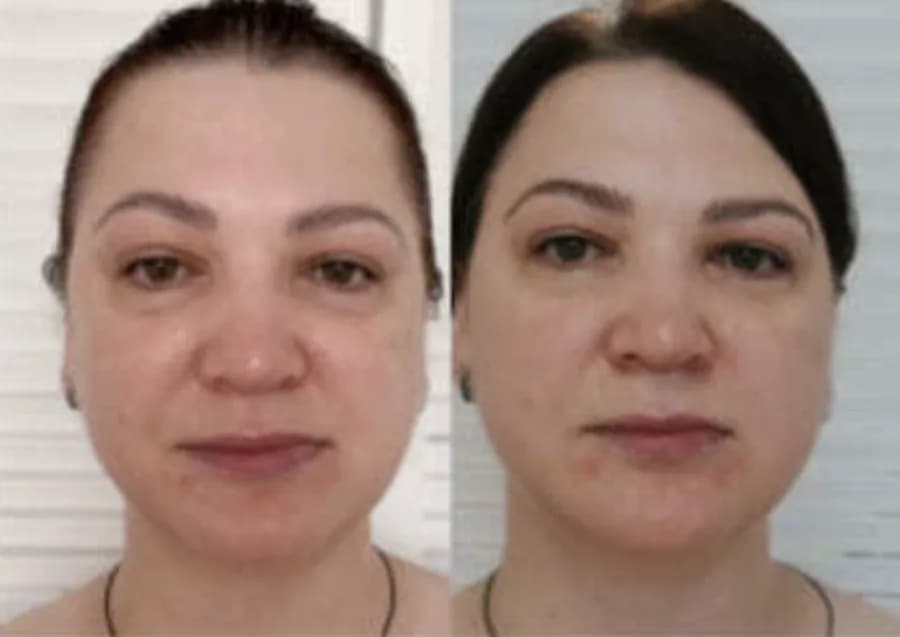 Reduced under-eye puffiness