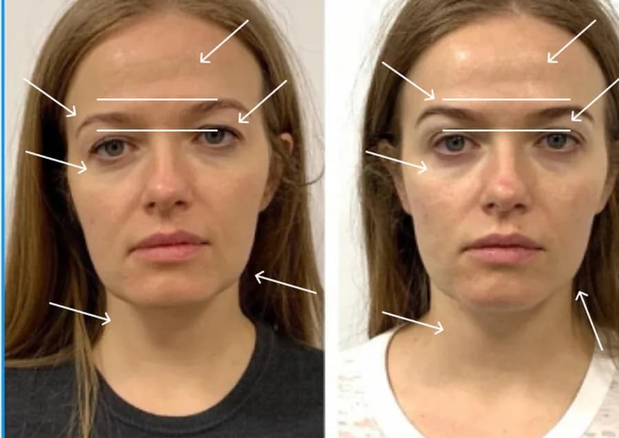 Eyelid level marked with lines