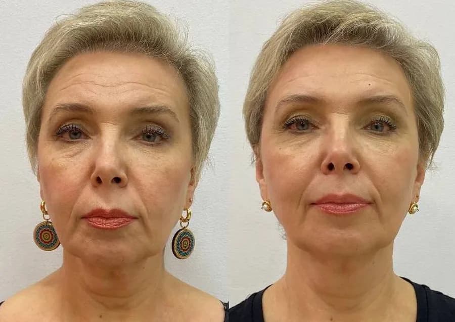 Reduced swelling around cheeks and jaw