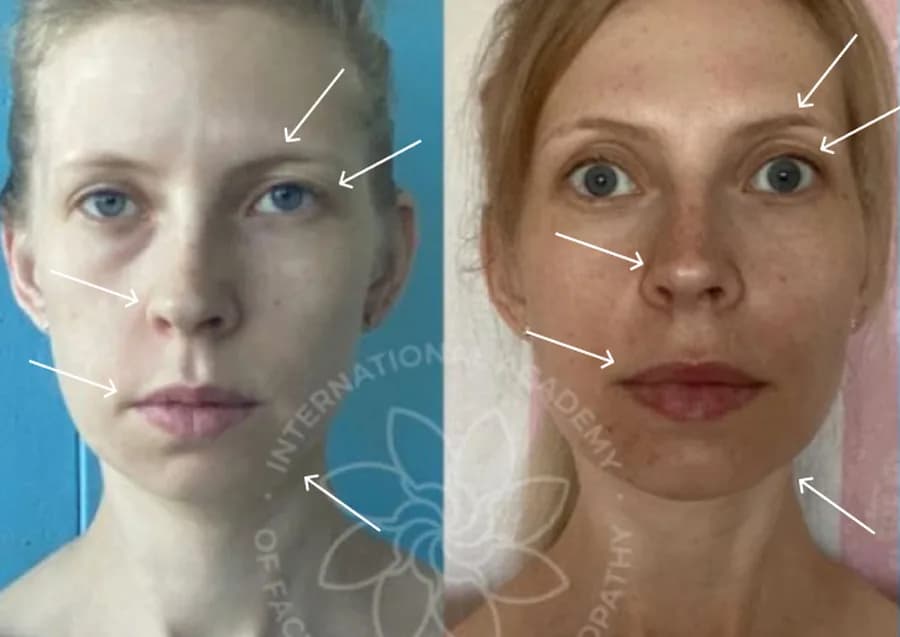 Reduced facial swelling, worked zones marked