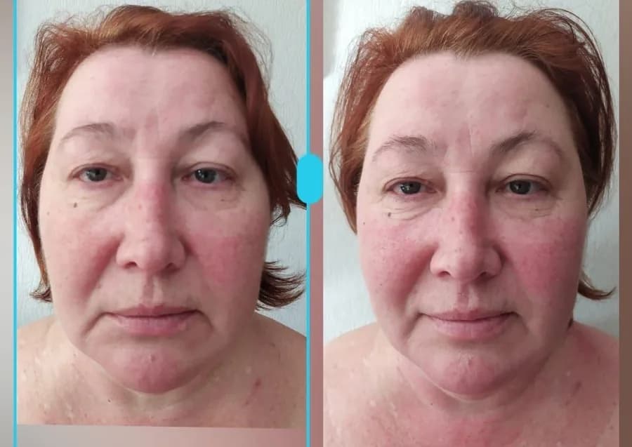 Reduced facial swelling and clearer contour
