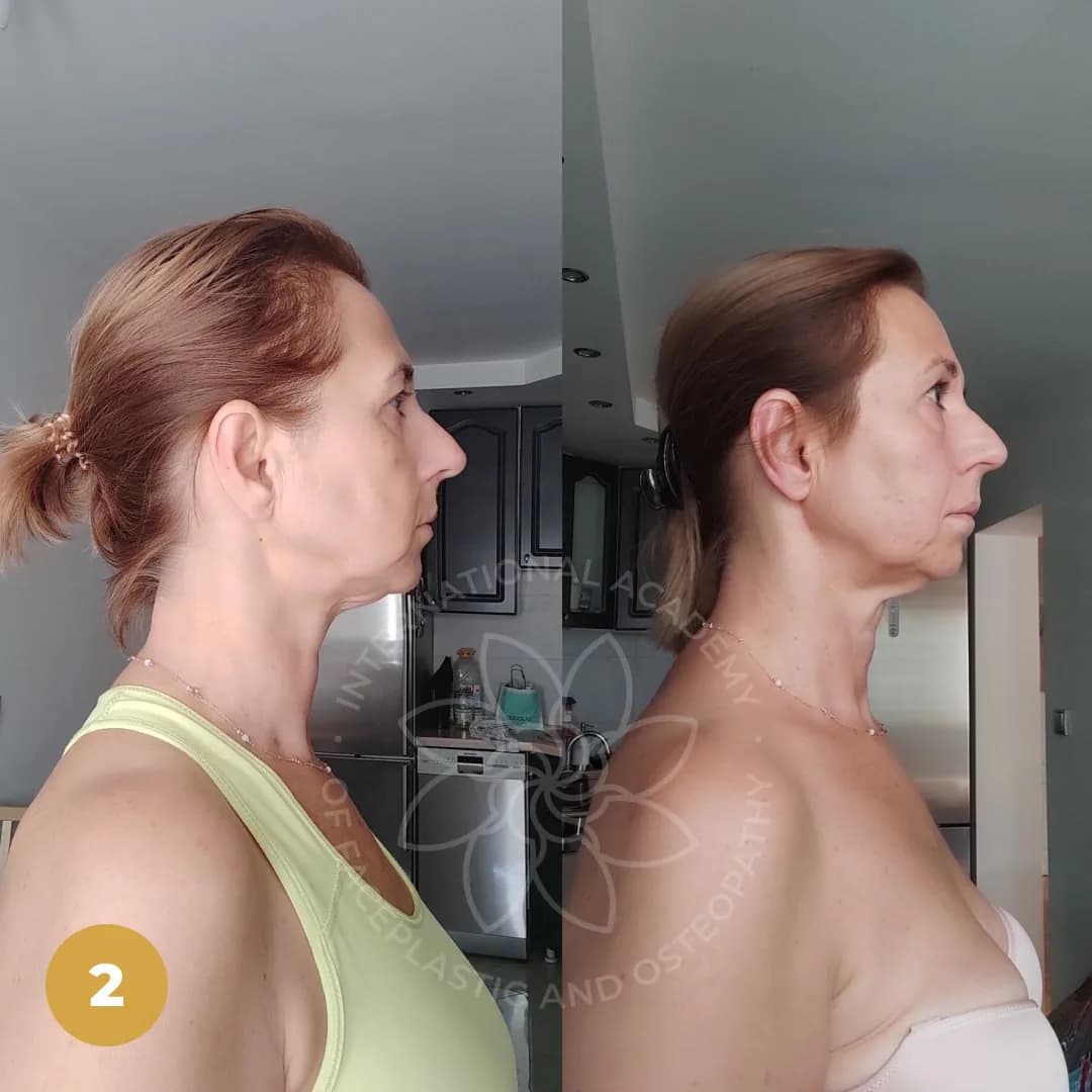 Before and after result 2