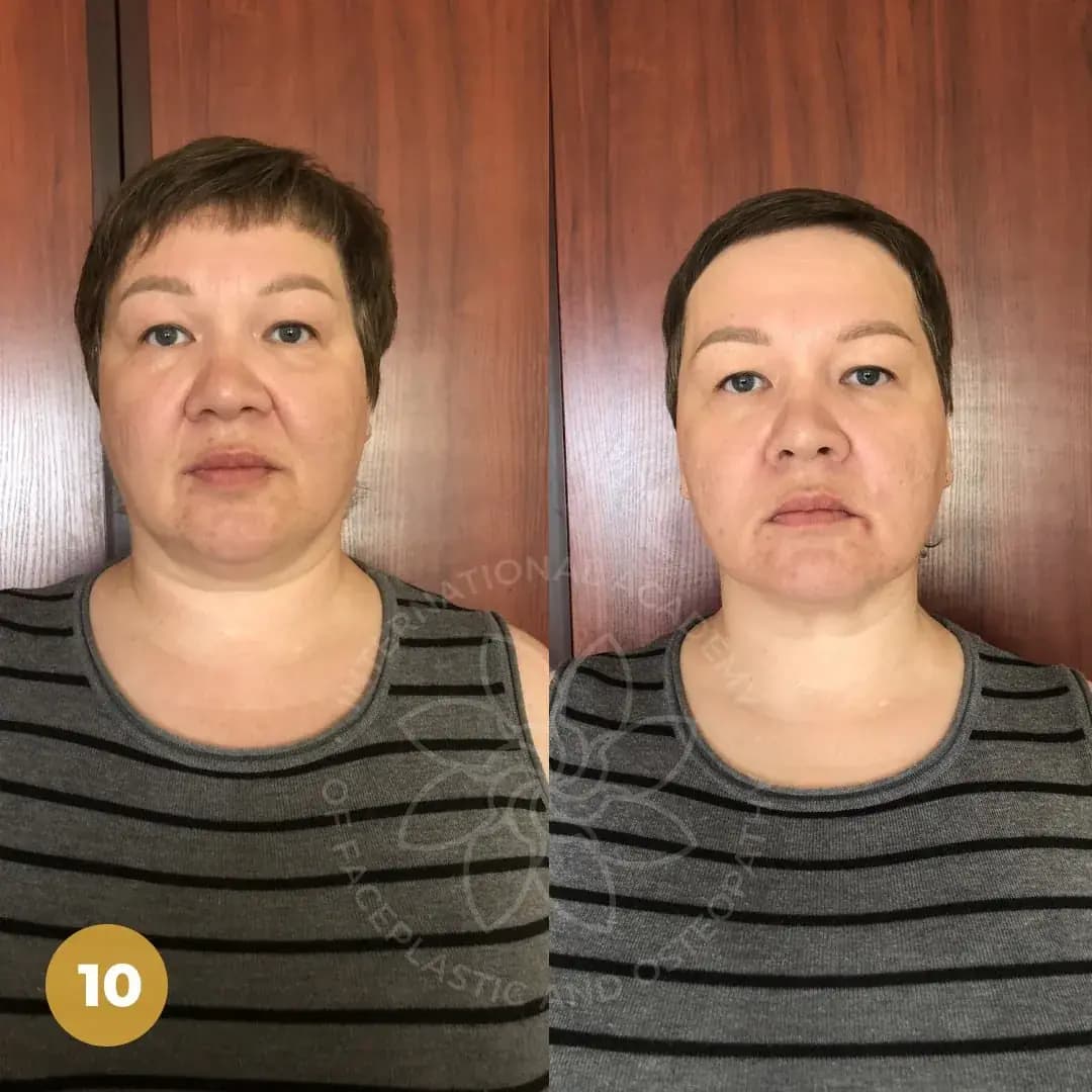 Before and after result 5