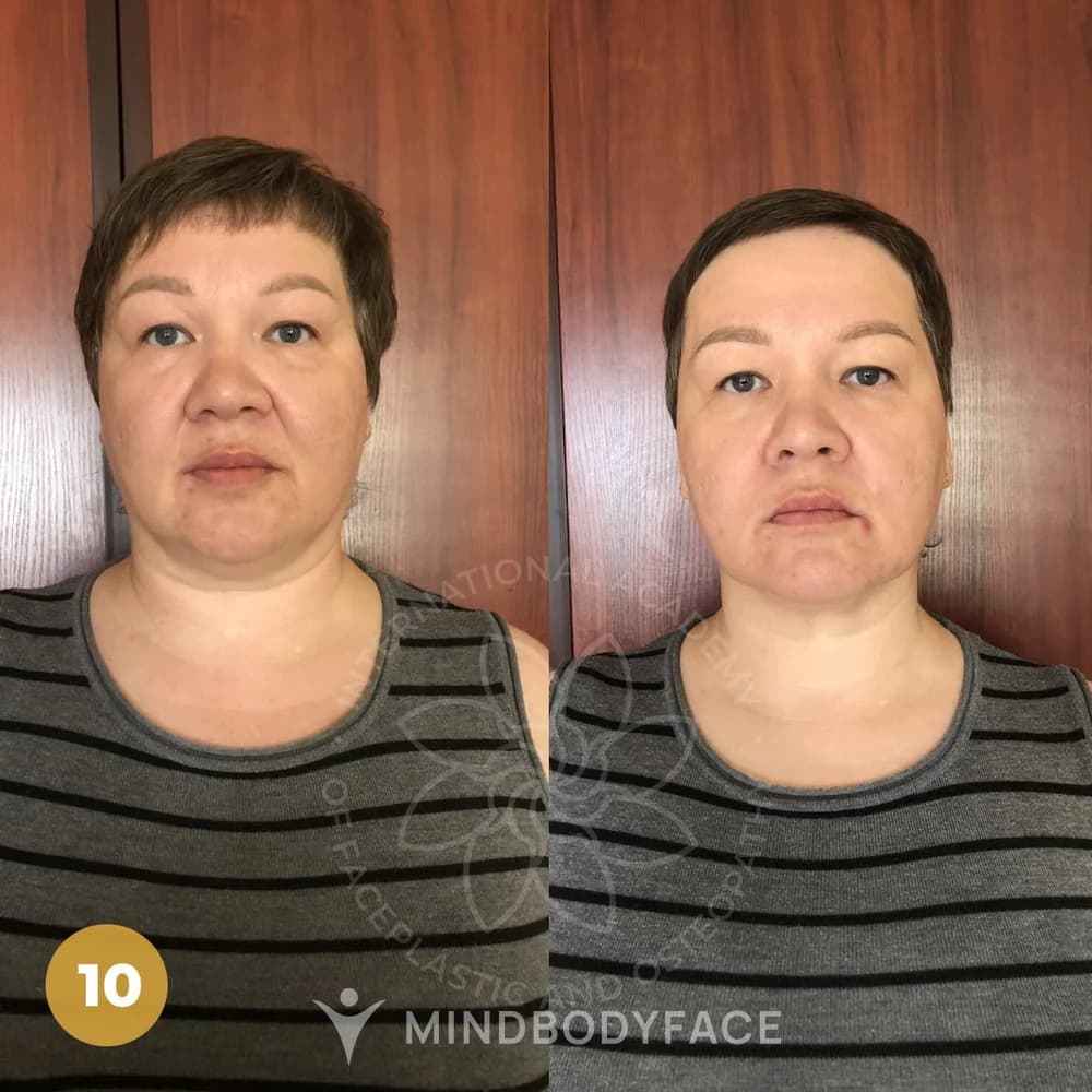 Before and after the Lymphatic Detox program