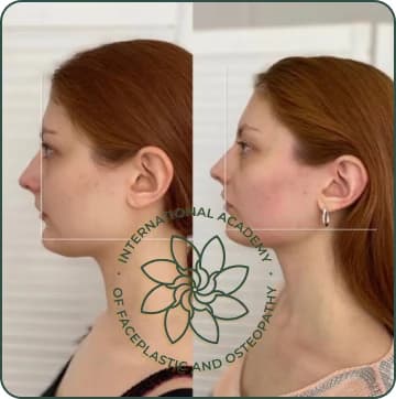 Chin became more defined and projected. Neckline improved and the double chin disappeared. Facial proportions became more balanced. Jaw–neck angle became more prominent and sharp