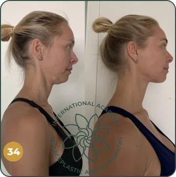 Double chin is gone. Jawline became more defined. Posture improved. Neck looks longer and more graceful