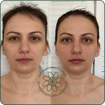 Nasolabial folds became less pronounced. Swelling in the lower face was reduced. Face became more symmetrical. Skin looks tighter and more refreshed
