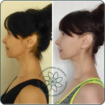 The lower face and chin were lifted. Neck contour became more defined. Puffiness around the cheeks and under the jaw reduced. The face looks lighter and more youthful overall