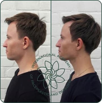 Improved posture and head position. Chin became more defined. Jaw angle is more pronounced. Face looks more structured and masculine