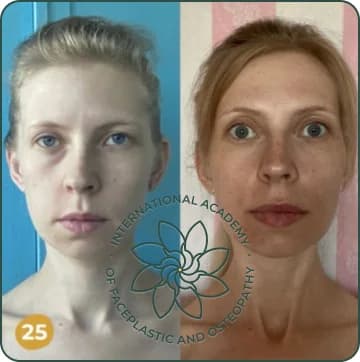 The face looks fuller and more vibrant. Shadows and tired look under the eyes are gone. Cheekbones and lips are more defined. Overall appearance is younger and healthier