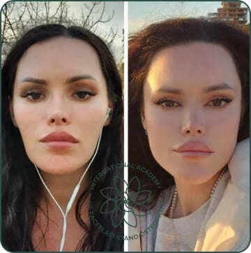 The face looks more lifted. Cheekbones became more defined. Puffiness and nasolabial folds have reduced. The eyes look fresher and more open. Facial asymmetry has noticeably improved