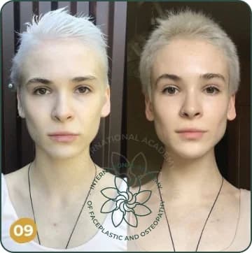 Cheekbones became more defined. The face looks more symmetrical and balanced. Eyes appear more open and expressive. Overall facial expression looks softer and more attractive