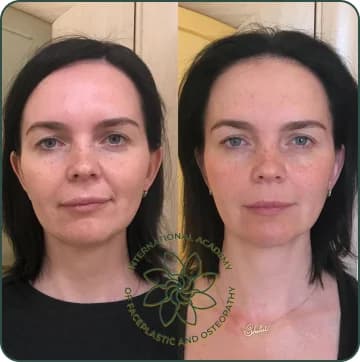 The face looks more lifted. Cheekbones became more defined. Puffiness and nasolabial folds have reduced. The eyes look fresher and more open. Facial asymmetry has noticeably improved