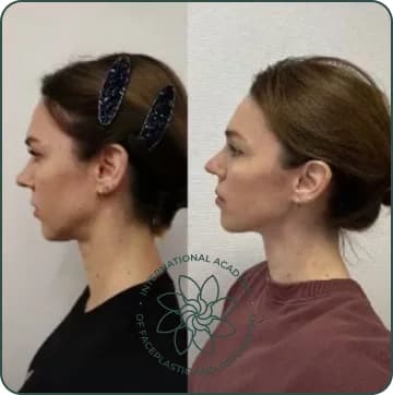 The chin has moved forward. The contour of the lower jaw have become more defined. The whole face looks younger, more composed and symmetrical