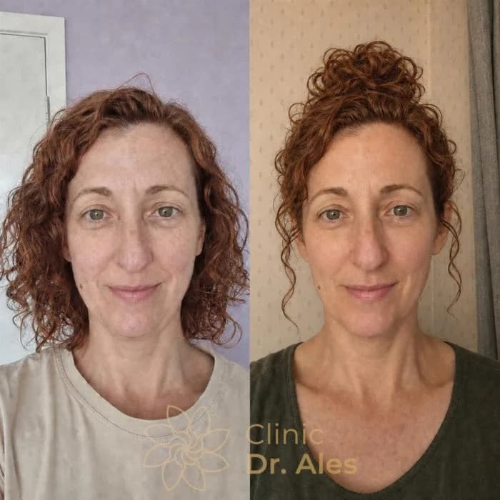 Before and after — Case 12: Softer nasolabial folds, more defined cheekbones