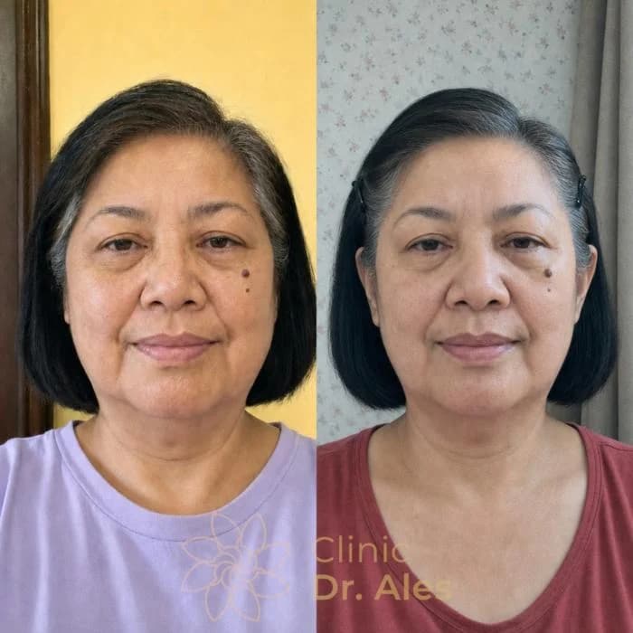Before and after — Case 13: Less pronounced lines, fresher expression