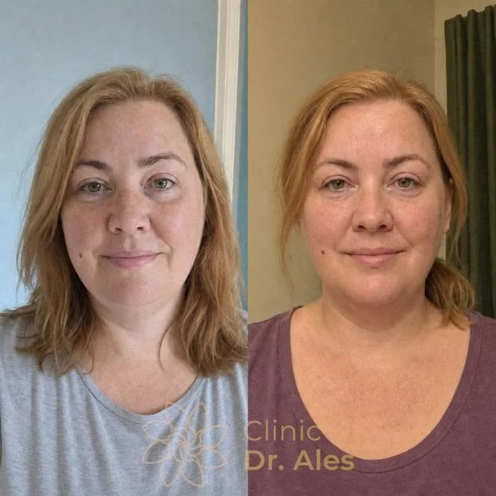 Before and after — Case 15: Shallower folds, more youthful mid-face contour