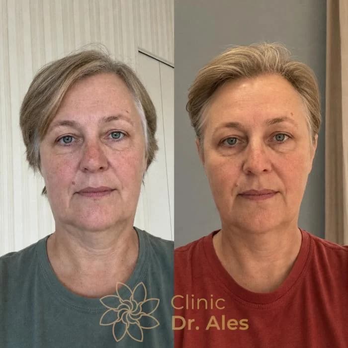 Before and after — Case 3: Less pronounced folds, more rested look