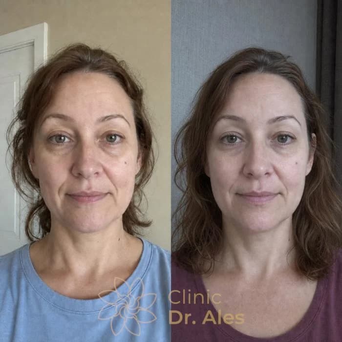 Before and after — Case 6: Smoother smile lines, cleaner lower-face contour