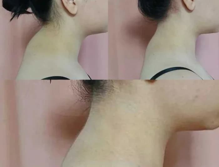 the neck lengthened and the posture improved. the head and neck are clearly more aligned. the double chin area looks tighter. shoulders appear more relaxed. the profile has become more elegant and uplifted