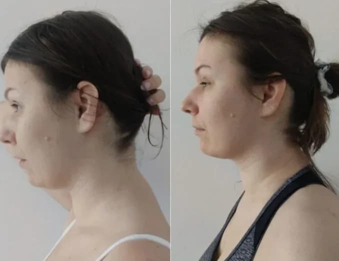the neck has become noticeably longer and straighter. the head position is now more upright and natural. the jawline looks more sculpted and firm. posture has improved, creating a more confident and lifted profile. the overall look is fresher, lighter, and more graceful