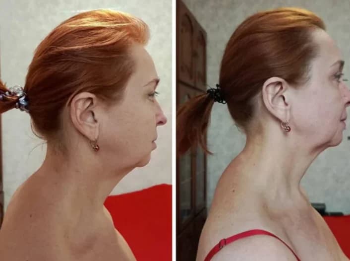 the double chin has significantly reduced. the neck has become longer and more defined. jawline contour is visibly sharper. posture has improved with an elegant lift through the upper body. the overall profile looks firmer, lighter, and noticeably younger