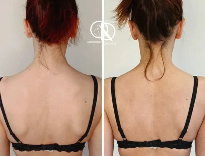 the shoulders have become more level and relaxed. the spine looks more aligned and centered. tension in the upper back has visibly reduced. the posture appears straighter and more balanced. the overall silhouette feels lighter and more harmonious