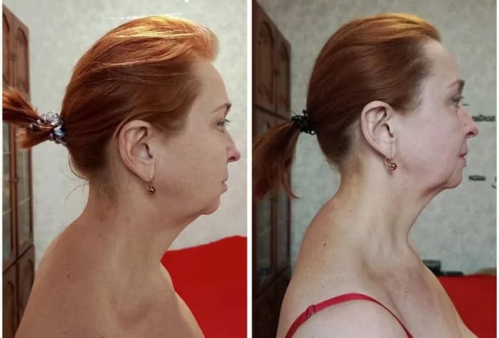 Age: 58 years · Using the method for: 2 months. The double chin has significantly reduced. The neck has become longer and more defined. Jawline contour is visibly sharper. Posture has improved with an elegant lift through the upper body. The overall profile looks firmer, lighter, and noticeably younger.