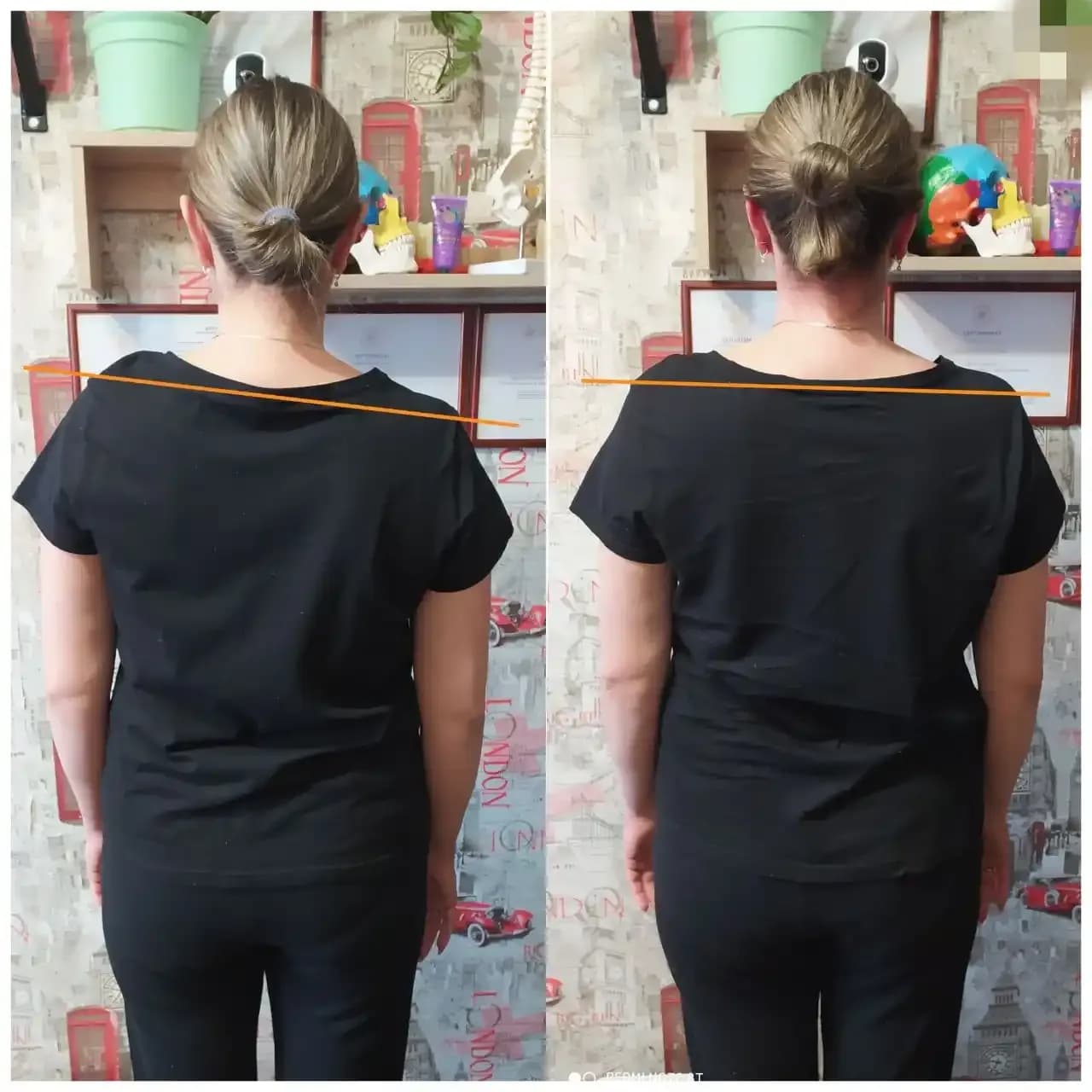 the shoulders appear noticeably more level and evenly positioned. the upper back looks more balanced from side to side. the neck appears more centered over the torso. the body shows less lateral tilt and a more symmetrical posture. the overall stance looks straighter and more stable