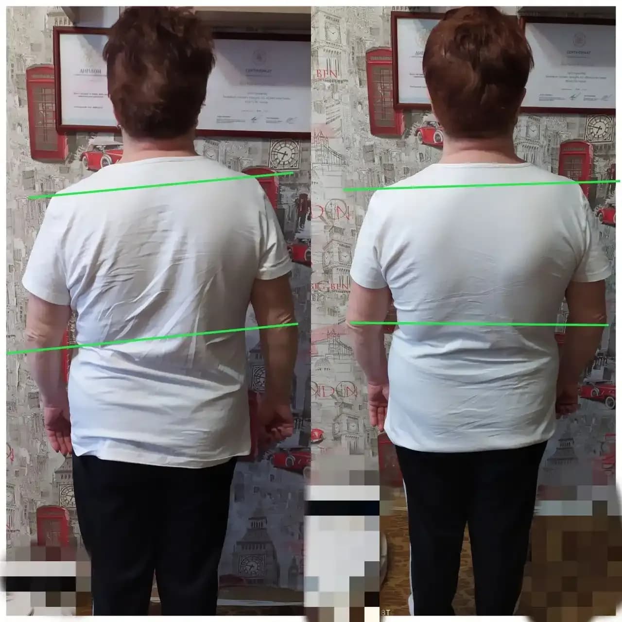 the shoulder line appears more level and balanced. the waist and lower back look more horizontally aligned. the torso shows less lateral tilt and appears more centered. the upper body looks more symmetrical from side to side. the overall posture appears straighter and more stable