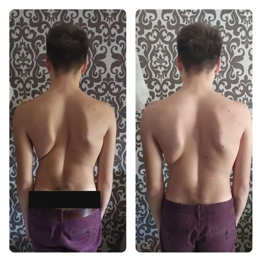 the shoulder blades appear more balanced and lie flatter against the back. the upper back looks more symmetrical, with less visible scapular winging. the torso appears straighter and more centered. the shoulders look more level and evenly positioned. the waistline appears more balanced, with less side-to-side shift
