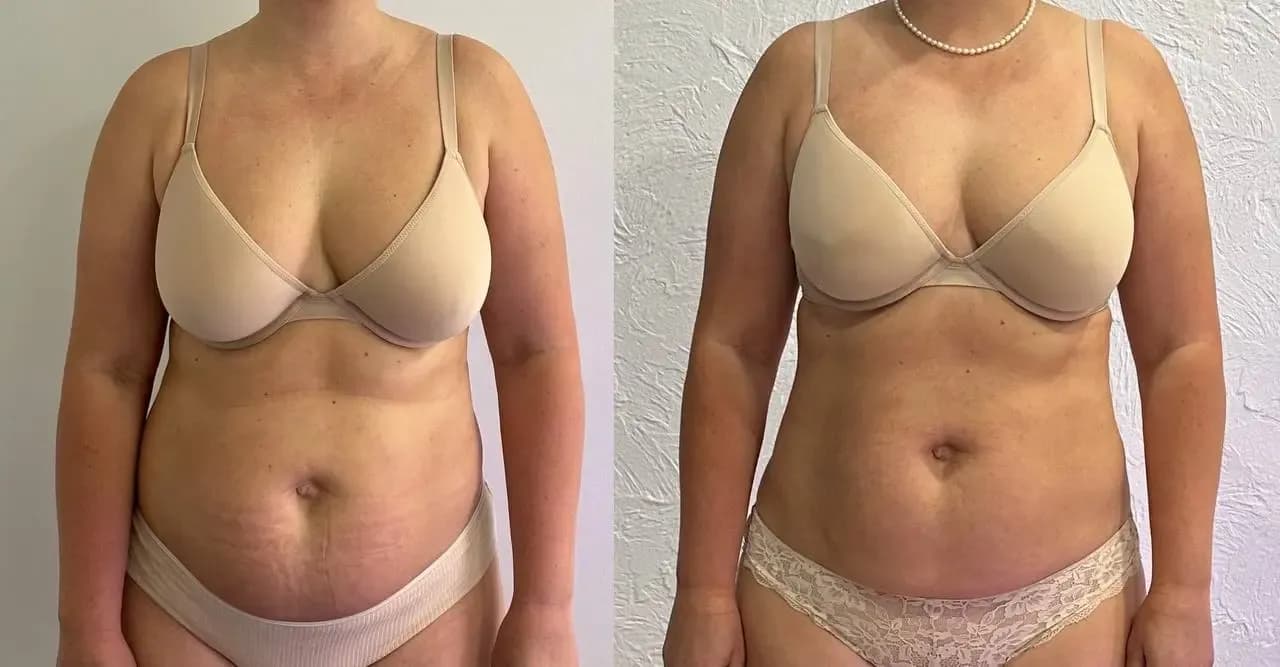 “For the first time in years, I feel like I’m standing tall”. Neutral position of the pelvis, this contributes to the better functioning of internal organs, improves blood circulation in the pelvic region and reduces the risk of stagnation of lymph and blood. The pelvis is stabilized, which means that the pelvic floor muscles, deep abdominal muscles and lower back work more efficiently, supporting the internal organs in the correct position. Tightened glutes and deep core muscles which lead to better body balance