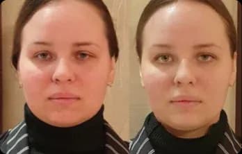 Facial contours look more defined, skin texture smoother, and the face overall appears fresher and more balanced.