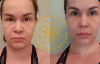 Wrinkles softened, the eyes look more open, facial contours tightened, and the face appears younger.