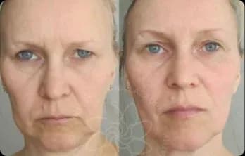 Swelling disappeared, facial contours tightened, and the face looks more sculpted and youthful.