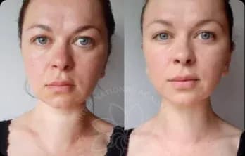 Facial puffiness disappeared; now the face looks younger and more refined.