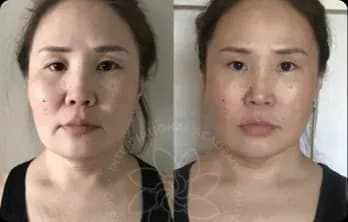 Swelling disappeared from the face, which now looks younger and more sculpted.